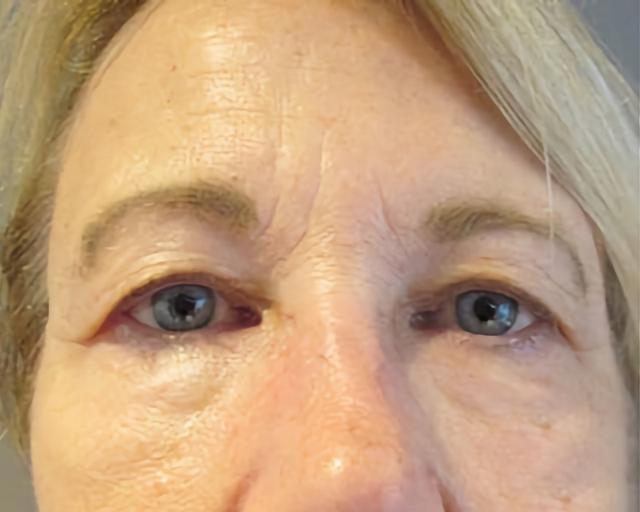 Blepharoplasty before at Esana Plastic Surgery Center & MedSpa in Guilford, CT