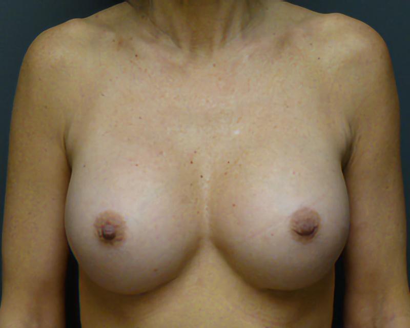 Esana Plastic Surgery Center & MedSpa breast augmentation after — Guilford, CT