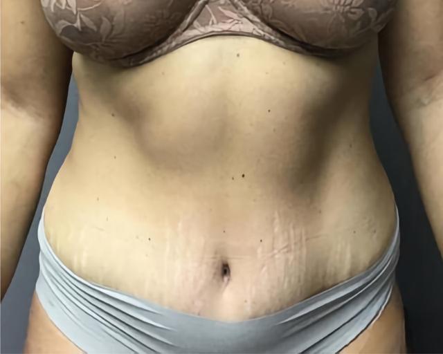 Tummy Tuck after at Esana Plastic Surgery Center & MedSpa in Guilford, CT