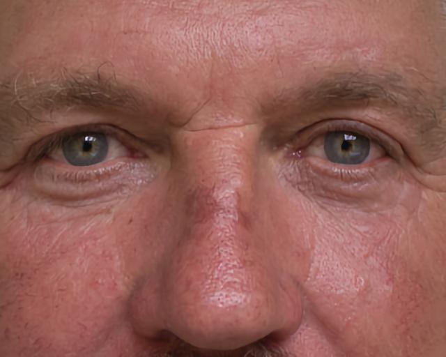 Blepharoplasty after at Esana Plastic Surgery Center & MedSpa in Guilford, CT