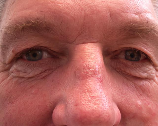 Blepharoplasty before at Esana Plastic Surgery Center & MedSpa in Guilford, CT