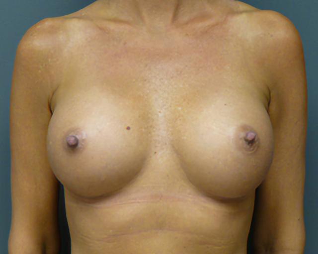 Fat Transfer Breast Augmentation after at Esana Plastic Surgery Center & MedSpa in Guilford, CT