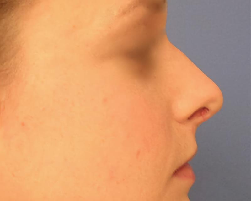 Esana Plastic Surgery Center & MedSpa rhinoplasty after — Guilford, CT