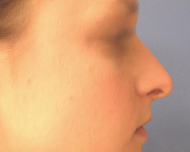 Liquid Rhinoplasty before at Esana Plastic Surgery Center & MedSpa in Guilford, CT