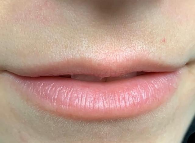 Juvederm before at Esana Plastic Surgery Center & MedSpa in Guilford, CT