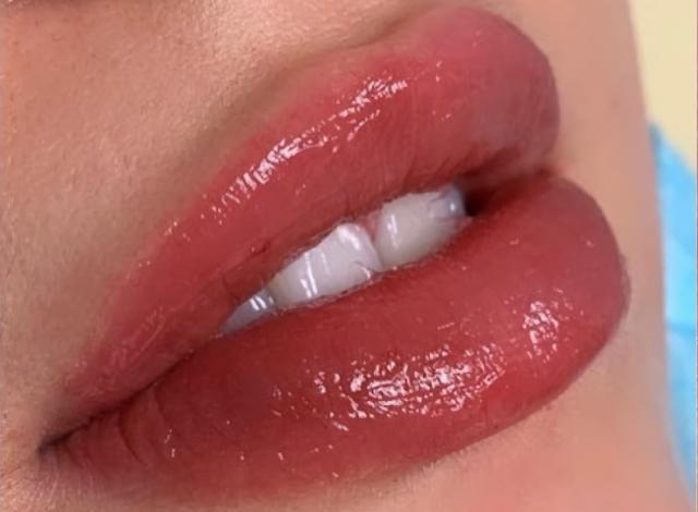 Juvederm after at Esana Plastic Surgery Center & MedSpa in Guilford, CT