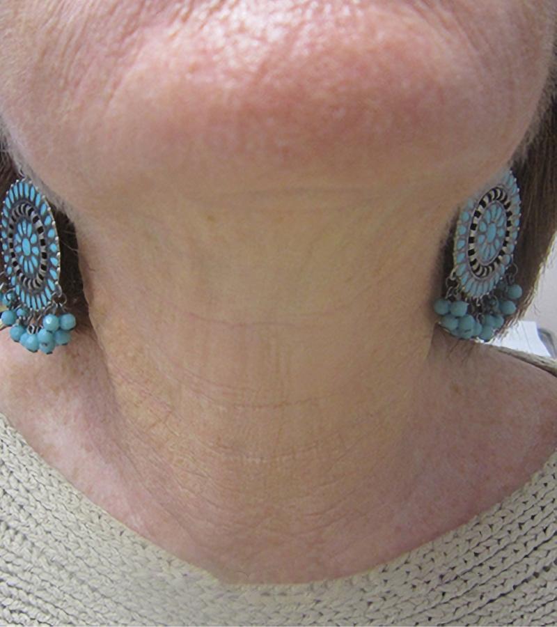 Esana Plastic Surgery Center & MedSpa skin tightening after — Guilford, CT