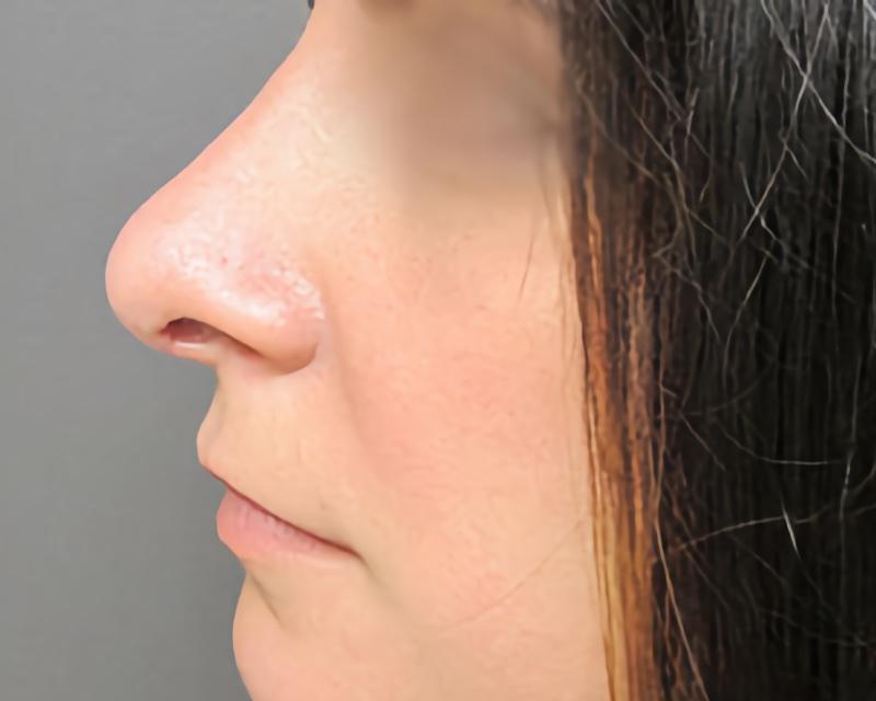 Esana Plastic Surgery Center & MedSpa rhinoplasty after — Guilford, CT