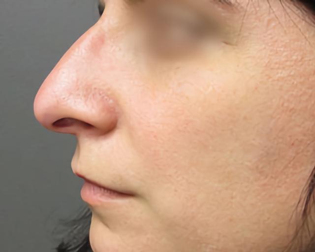Liquid Rhinoplasty before at Esana Plastic Surgery Center & MedSpa in Guilford, CT