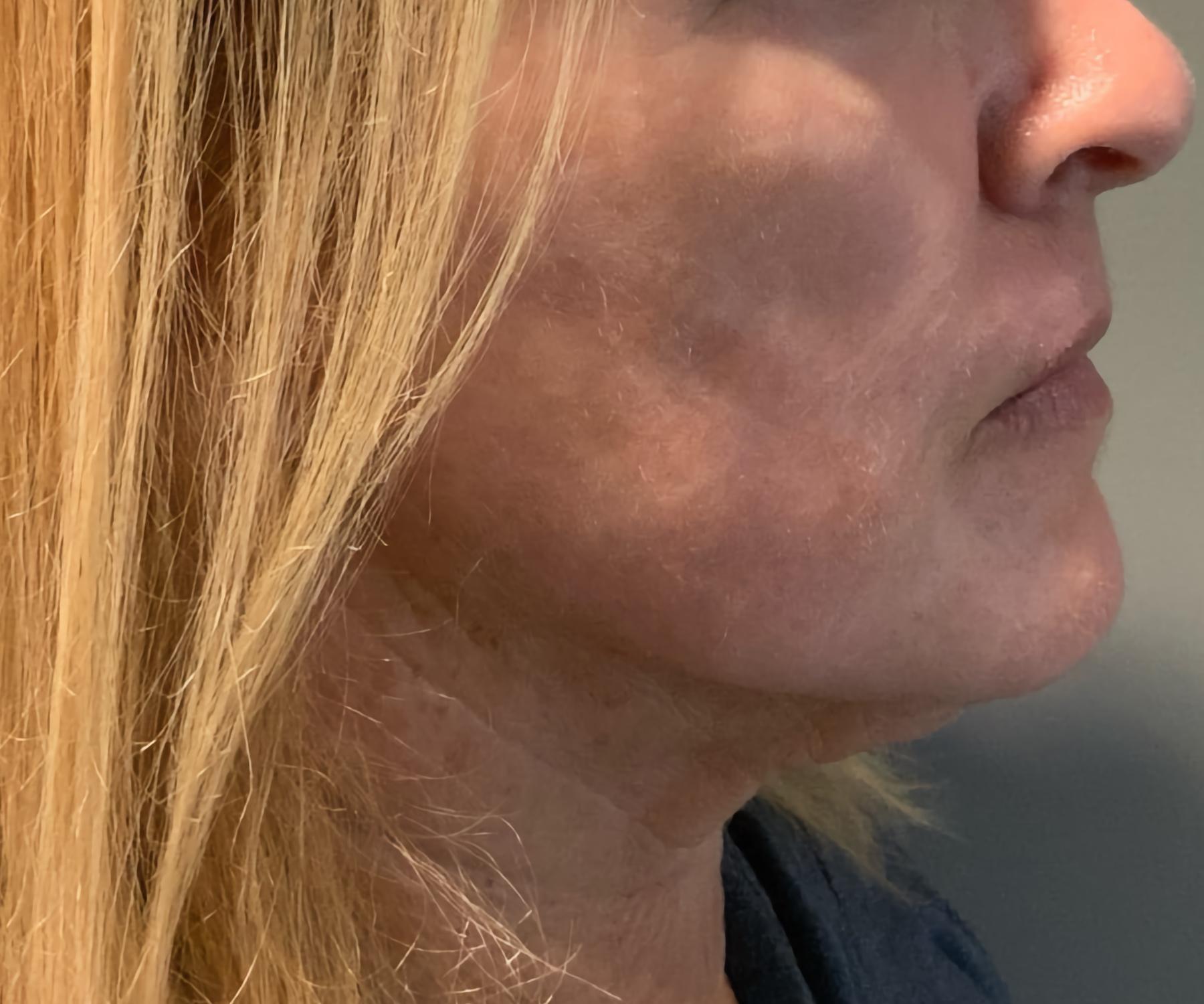 Esana Plastic Surgery Center & MedSpa chemical peel after — Guilford, CT