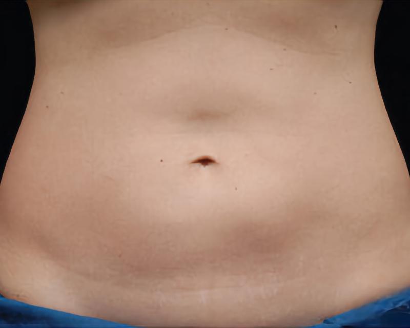 Esana Plastic Surgery Center & MedSpa coolsculpting after — Guilford, CT