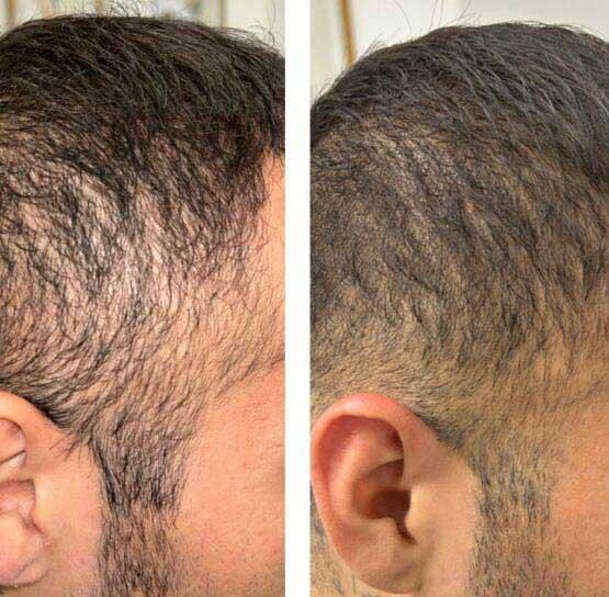 Face Works Plastic Surgery & Med Spa hair restoration result — Schaumburg, IL