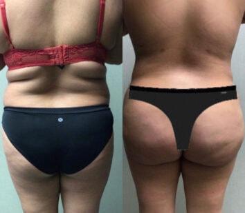 Face Works Plastic Surgery & Med Spa liposuction result — Schaumburg, IL
