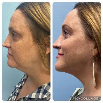 Face Works Plastic Surgery & Med Spa neck liposuction result — Schaumburg, IL