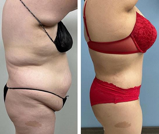 Face Works Plastic Surgery & Med Spa mommy makeover result — Schaumburg, IL