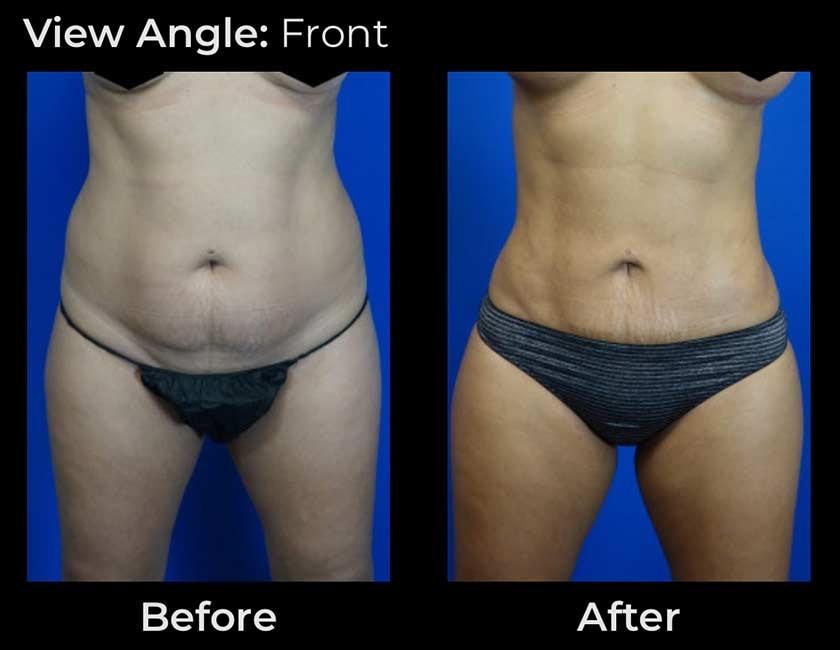 Face Works Plastic Surgery & Med Spa liposuction result — Schaumburg, IL