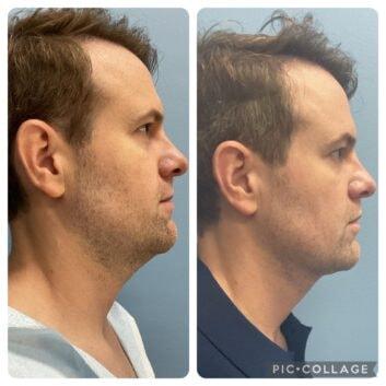 Face Works Plastic Surgery & Med Spa neck liposuction result — Schaumburg, IL