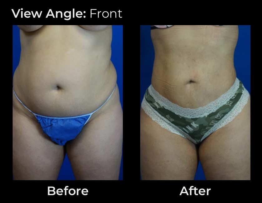 Face Works Plastic Surgery & Med Spa liposuction result — Schaumburg, IL