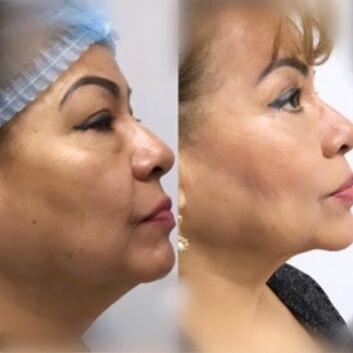 Face Works Plastic Surgery & Med Spa neck liposuction result — Schaumburg, IL