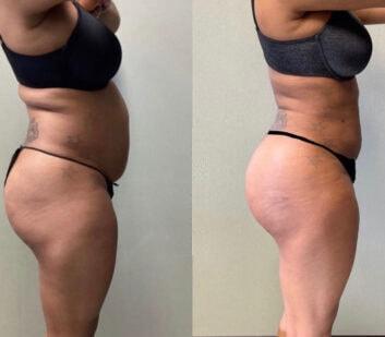 Face Works Plastic Surgery & Med Spa liposuction result — Schaumburg, IL