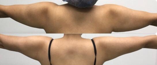 Face Works Plastic Surgery & Med Spa liposuction result — Schaumburg, IL