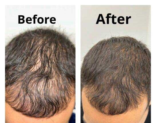 Face Works Plastic Surgery & Med Spa hair restoration result — Schaumburg, IL