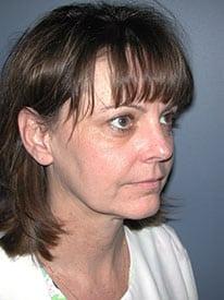 Deep Plane Facelift before at Louis L. Strock M.D., P.A. in Fort Worth, TX