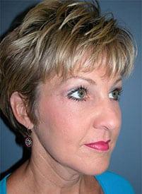 Facelift after at Louis L. Strock M.D., P.A. in Fort Worth, TX