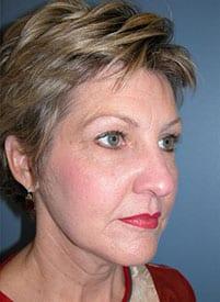 Facelift before at Louis L. Strock M.D., P.A. in Fort Worth, TX