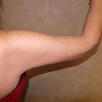 Arm Lift after at Louis L. Strock M.D., P.A. in Fort Worth, TX
