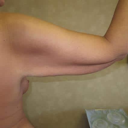 Arm Lift before at Louis L. Strock M.D., P.A. in Fort Worth, TX