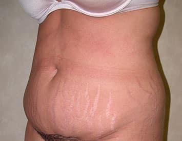 Mini Tummy Tuck before at Louis L. Strock M.D., P.A. in Fort Worth, TX