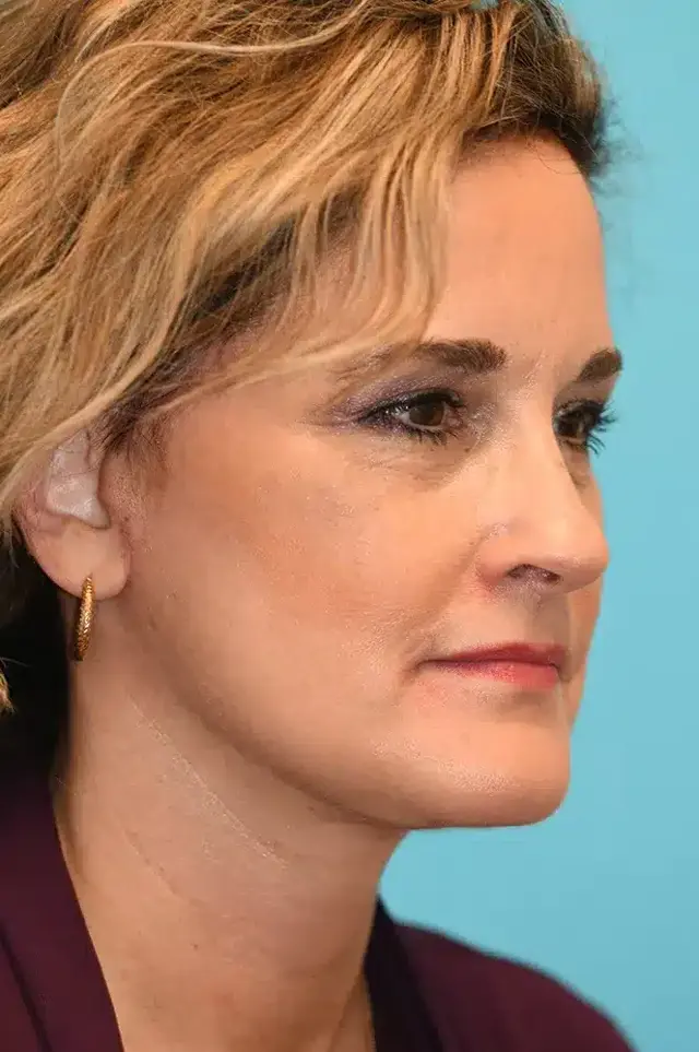 Neck Lift after at David A. Hecht, MD, PC in Scottsdale, AZ