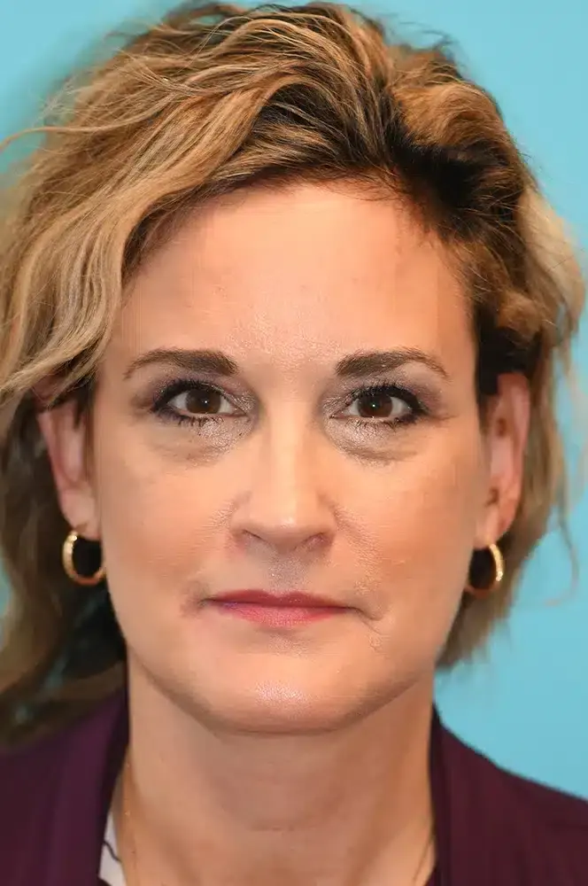 David A. Hecht, MD, PC facelift after — Scottsdale, AZ