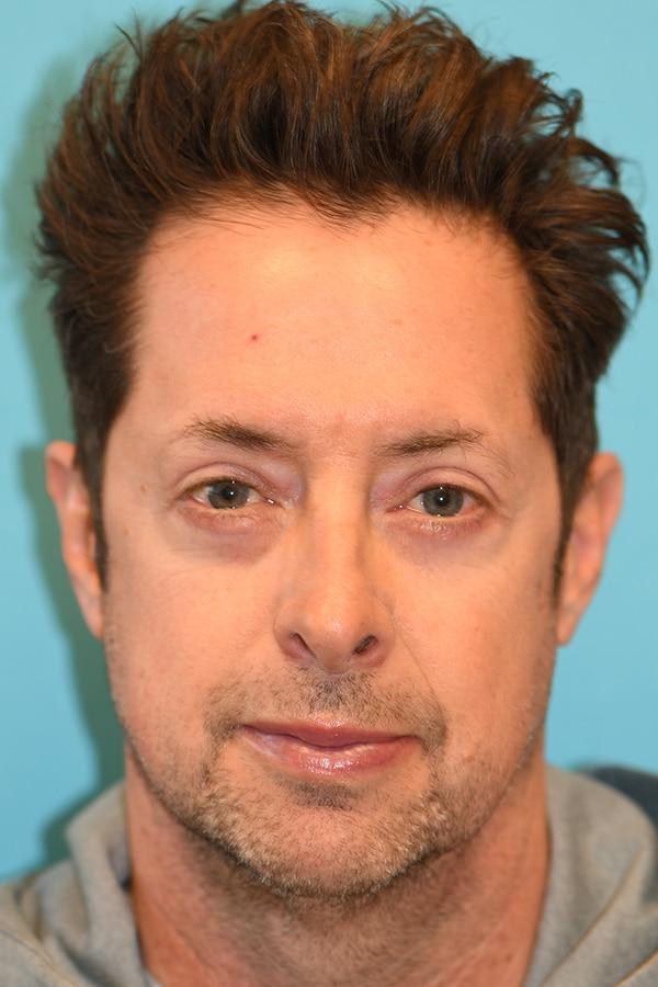 David A. Hecht, MD, PC blepharoplasty after — Scottsdale, AZ