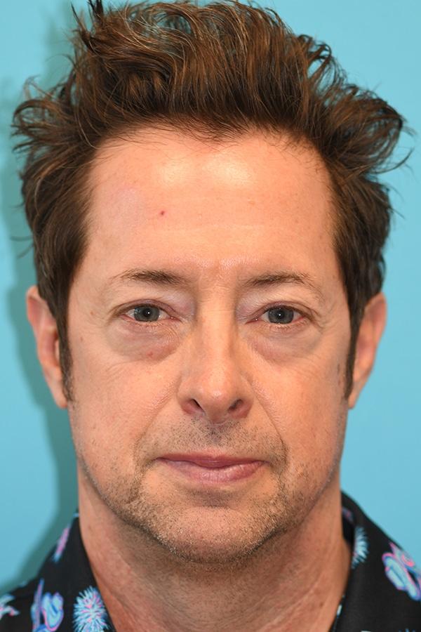 Blepharoplasty before at David A. Hecht, MD, PC in Scottsdale, AZ