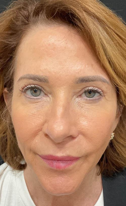 Ravive Plastic Surgery & MedSpa eyelid lift after — Tampa, FL