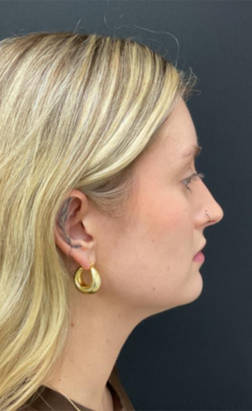 Neck Liposuction before at Ravive Plastic Surgery & MedSpa in Tampa, FL