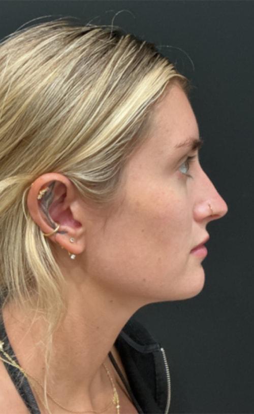 Neck Liposuction after at Ravive Plastic Surgery & MedSpa in Tampa, FL