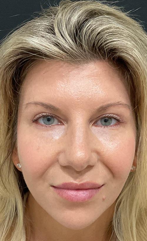 Ravive Plastic Surgery & MedSpa eyelid lift after — Tampa, FL