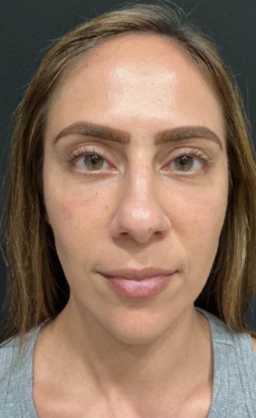Ravive Plastic Surgery & MedSpa eyelid lift after — Tampa, FL