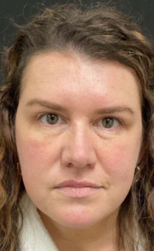 Ravive Plastic Surgery & MedSpa eyelid lift after — Tampa, FL