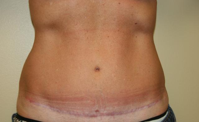 Tummy Tuck after at Aesthetic Plastic Surgery Associates in Knoxville, TN