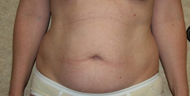 Tummy Tuck before at Aesthetic Plastic Surgery Associates in Knoxville, TN