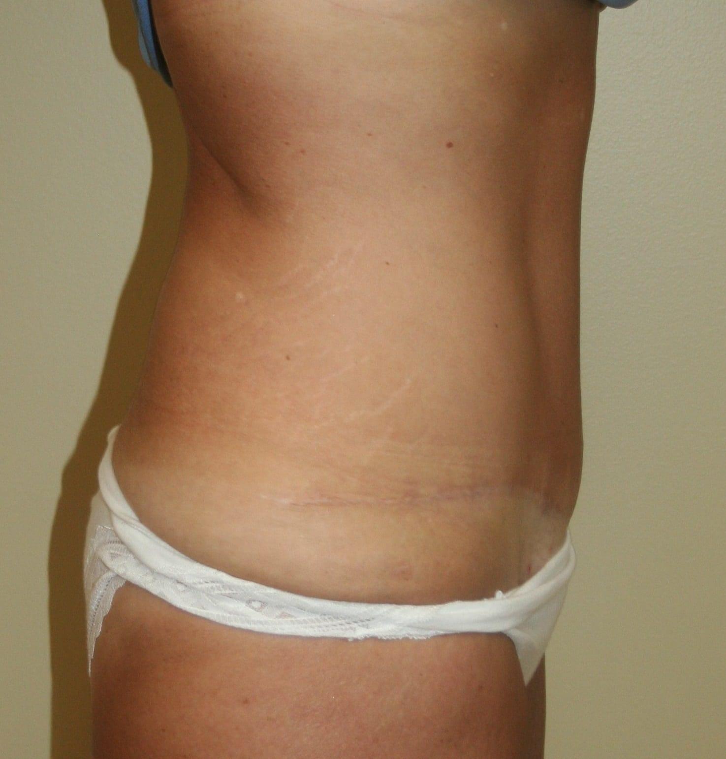 Aesthetic Plastic Surgery Associates tummy tuck after — Knoxville, TN