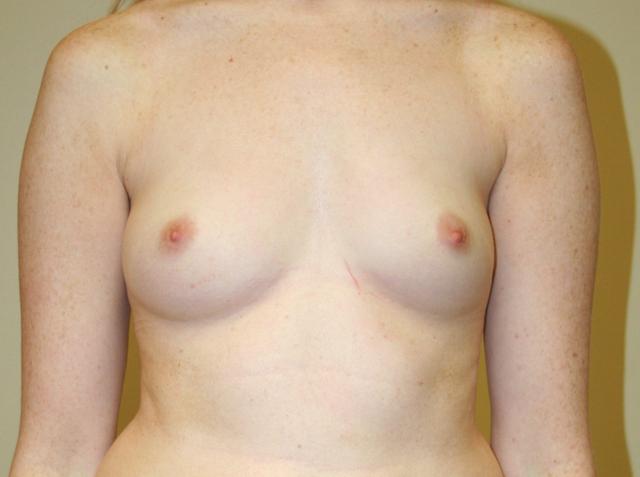 Breast Augmentation before at Aesthetic Plastic Surgery Associates in Knoxville, TN