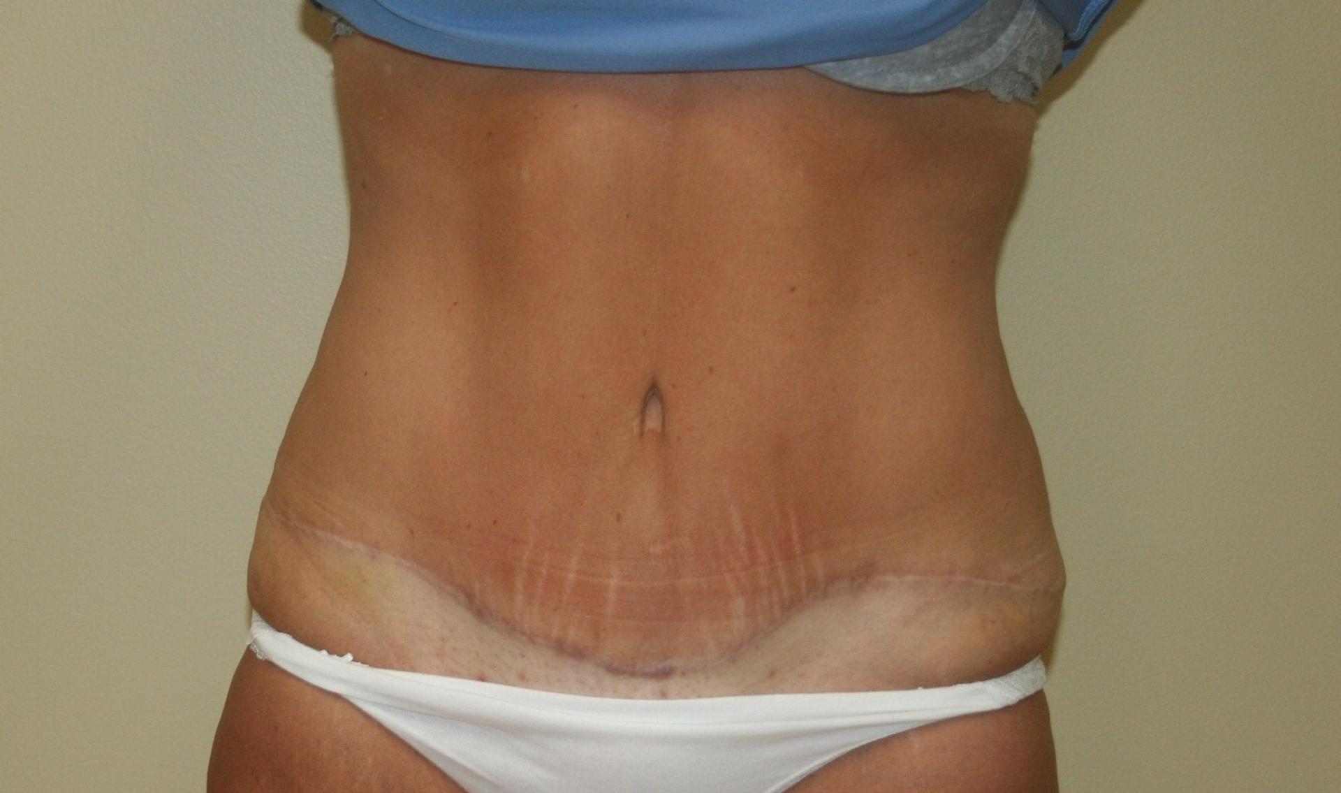 Aesthetic Plastic Surgery Associates tummy tuck after — Knoxville, TN