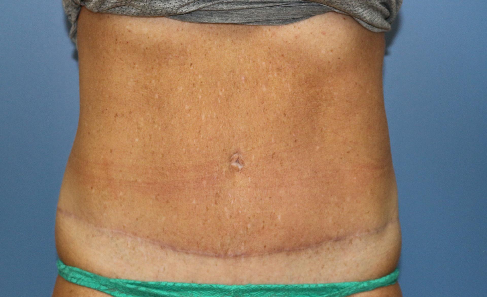 Aesthetic Plastic Surgery Associates tummy tuck after — Knoxville, TN