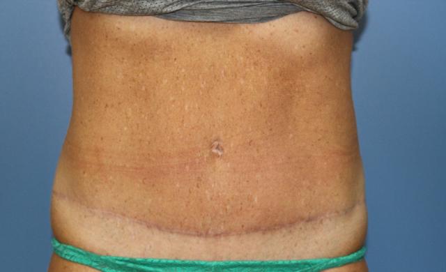 Tummy Tuck after at Aesthetic Plastic Surgery Associates in Knoxville, TN