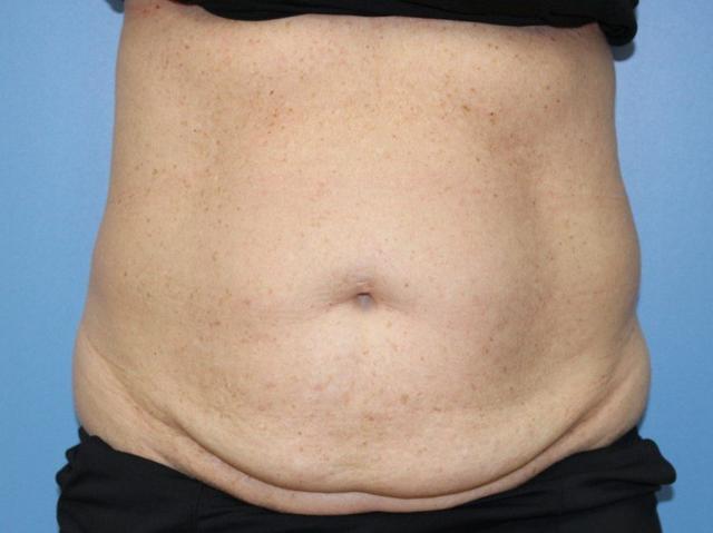 Tummy Tuck before at Aesthetic Plastic Surgery Associates in Knoxville, TN